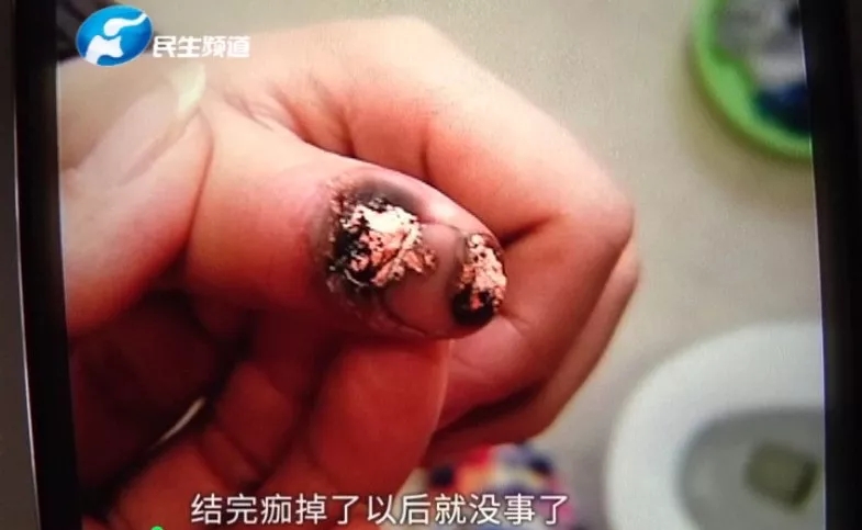8岁男童烂指甲,8岁男童指甲烂掉