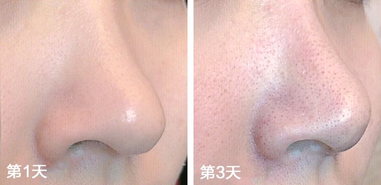 超级黑头正确处理方法,黑头别膨胀3招把你刷光光