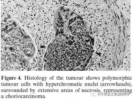 肺动脉分支充盈欠佳是肺栓塞吗,肺动脉缺损不可逆