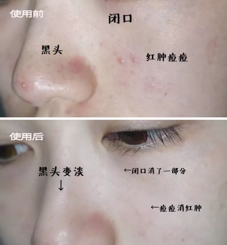 脸上搓下来很多泥,脸上搓出黑头