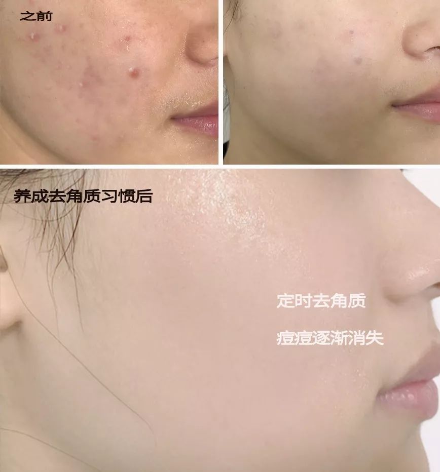 脸上搓下来很多泥,脸上搓出黑头