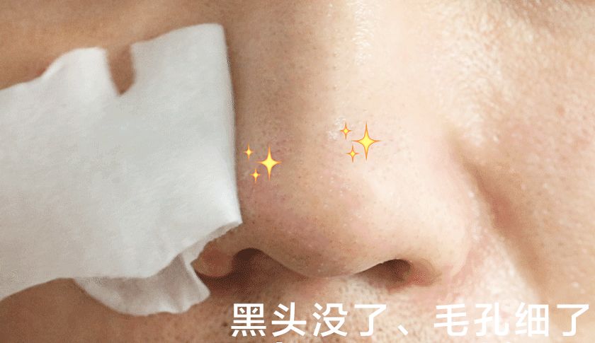 超级黑头正确处理方法,黑头别膨胀3招把你刷光光