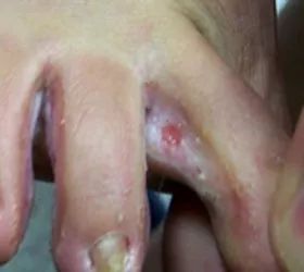 足癣冷知识,杏林微科普预防秋燥的方法