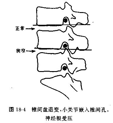 一分钟带你了解腰椎狭窄,椎管狭窄症知识大全