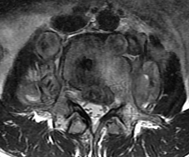 一分钟带你了解腰椎狭窄,椎管狭窄症知识大全