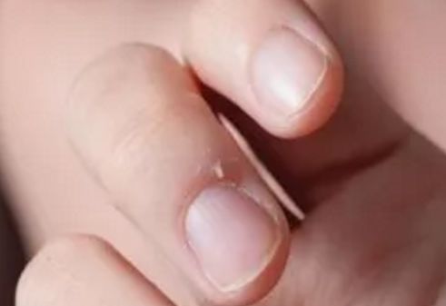 手指倒刺拔了变硬,手指倒刺顺着拔