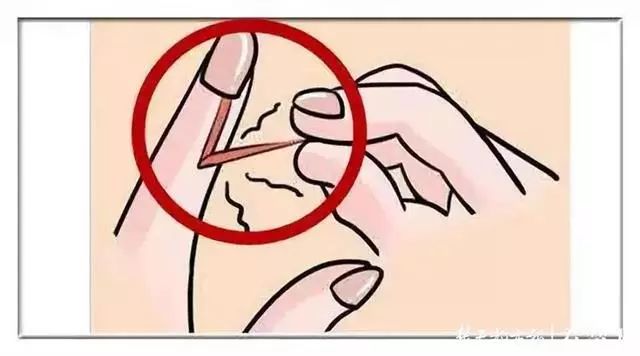 一个没注意,手指倒刺变截指!这个动作千万别再做了!