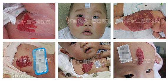 宝宝身上起红点当心这些皮肤病,婴儿皮肤起小红点一定是血管瘤吗