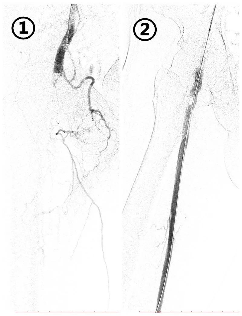 一条腿截肢了什么感觉,一条腿截肢了犯了重罪怎么办