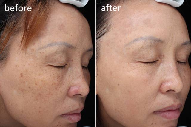 ‘斑’弄是非，超皮秒要你好看