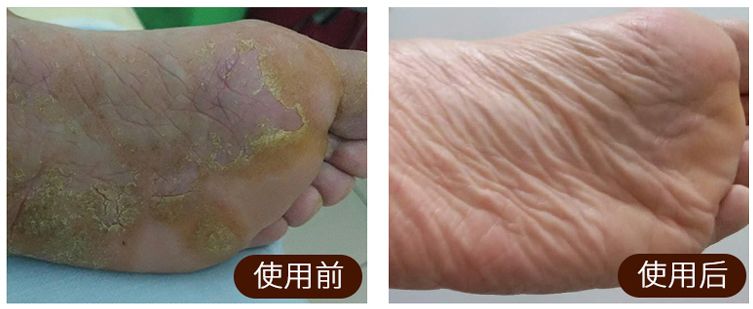 足癣湿疹用什么药膏最有效,皮炎湿疹足癣
