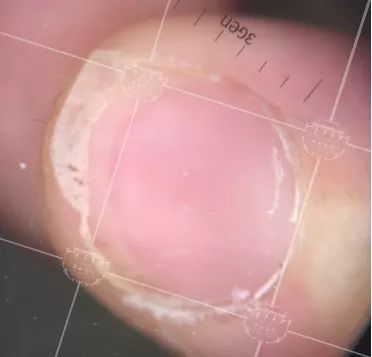 灰指甲致癌吗,灰指甲美甲的禁忌