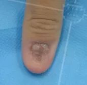 灰指甲美甲处理,灰指甲霉菌感染致癌