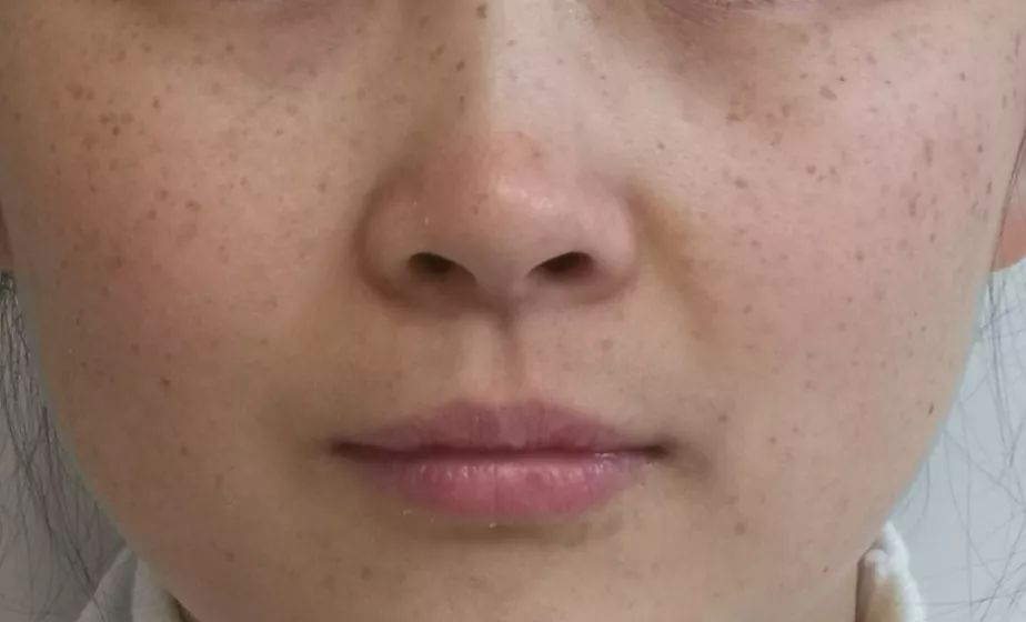 雀斑样痣和雀斑的区别有哪些,雀斑和青褐色痣