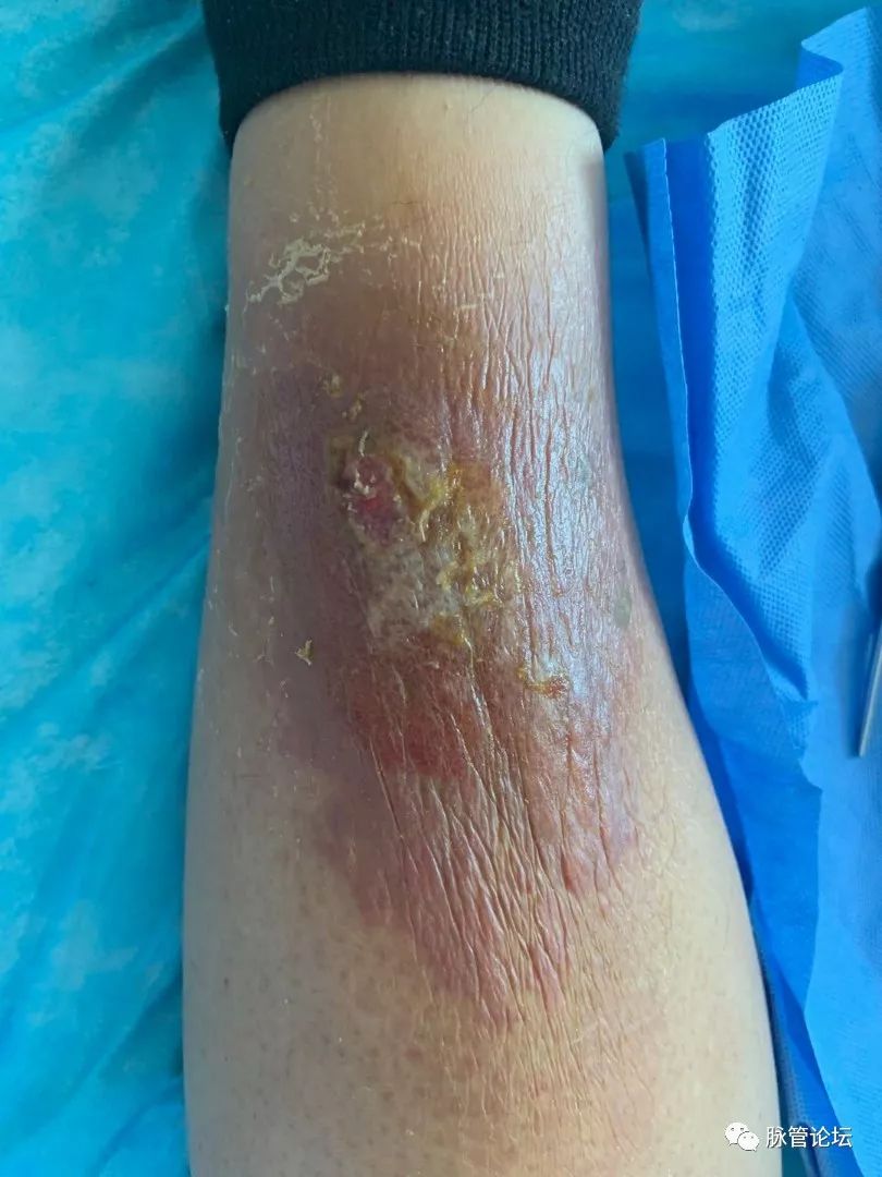 足癣引起丹毒的症状,杏林微科普如何识别癣类疾病