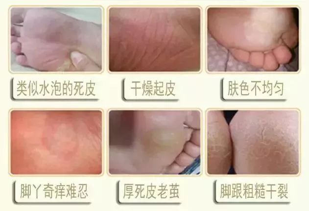 娇嫩双足|堪比“换皮术”的逆天足膜！让双脚像剥鸡蛋壳一样轻松换新皮！60分钟还你柔嫩美足