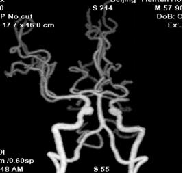 Reco特约·第10期｜国产组合助力取栓“一把通”——Ewata球囊导引导管联合Reco支架取栓分享