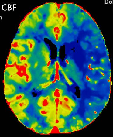 Reco特约·第10期｜国产组合助力取栓“一把通”——Ewata球囊导引导管联合Reco支架取栓分享