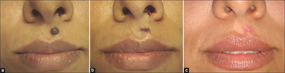 突然长痣是不是出了什么问题知乎,女人左手背突然长痣代表什么