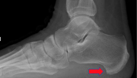 足底筋膜炎与足跟骨刺的治疗方法,筋骨堂治疗骨质增生能去掉吗