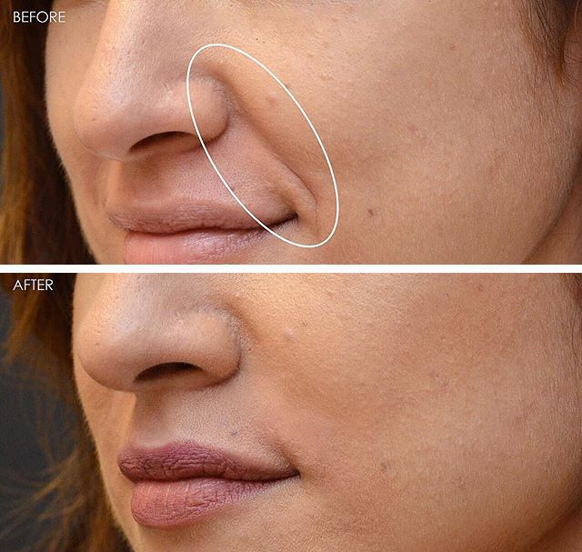 消除眉间法令纹最有效的方法,眉间纹和法令纹医美