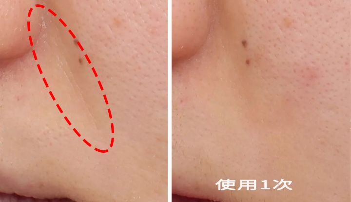 法令纹又黑又长,法令纹又深又长好吗