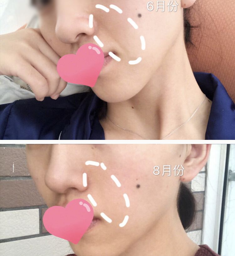 眉间纹和法令纹除皱针能去掉吗,嘴角纹法令纹抬头纹国货推荐