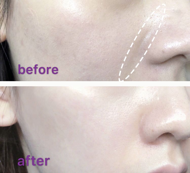 眉间纹和法令纹除皱针能去掉吗,嘴角纹法令纹抬头纹国货推荐