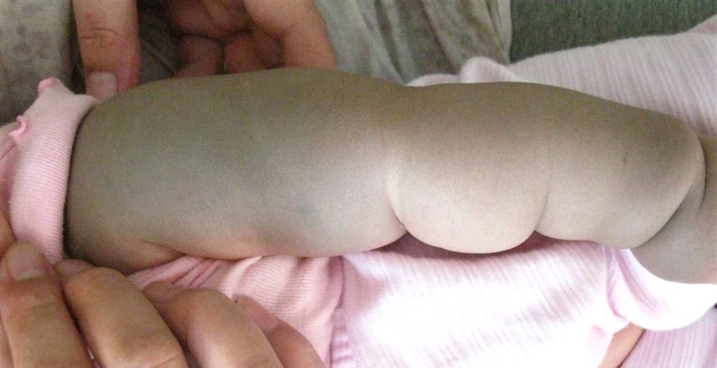 宝宝出生有乌青怎么回事,宝宝出生屁屁上都有淤青吗