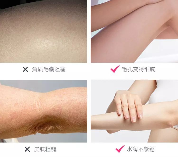 可美金箔祛痘螨虫皂,除螨皂能祛螨虫吗