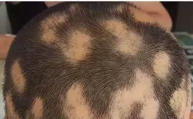 鬼剃头究竟是怎么回事,鬼剃头是谁发现的