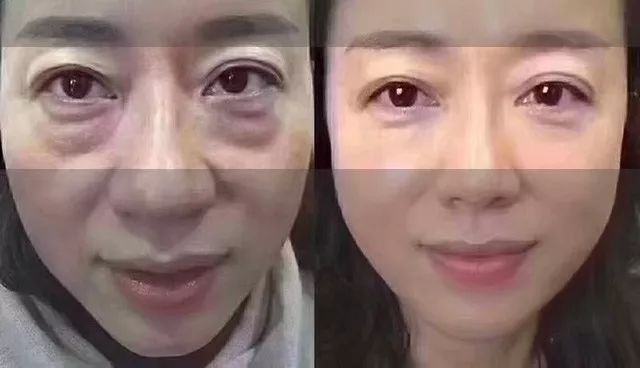 眼袋松弛下垂最快解决方法,严重眼袋下垂松弛怎么恢复