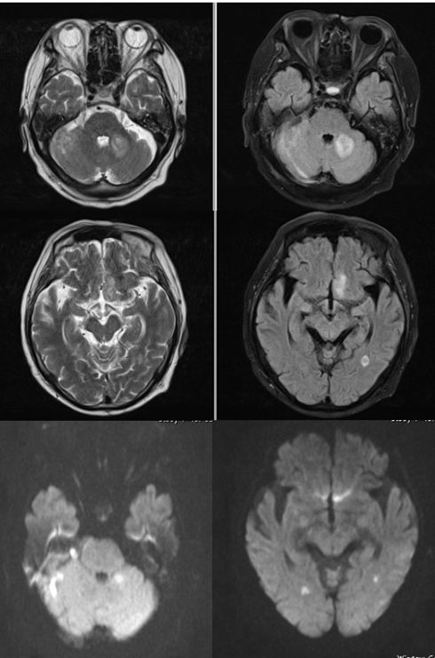 Rasmussen脑炎、结核性肉芽肿、脑发育性静脉畸形丨3分钟读片·第13期,下）