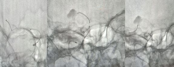 治疗颅内动脉瘤新型密网支架,pipeline治疗椎动脉夹层动脉瘤
