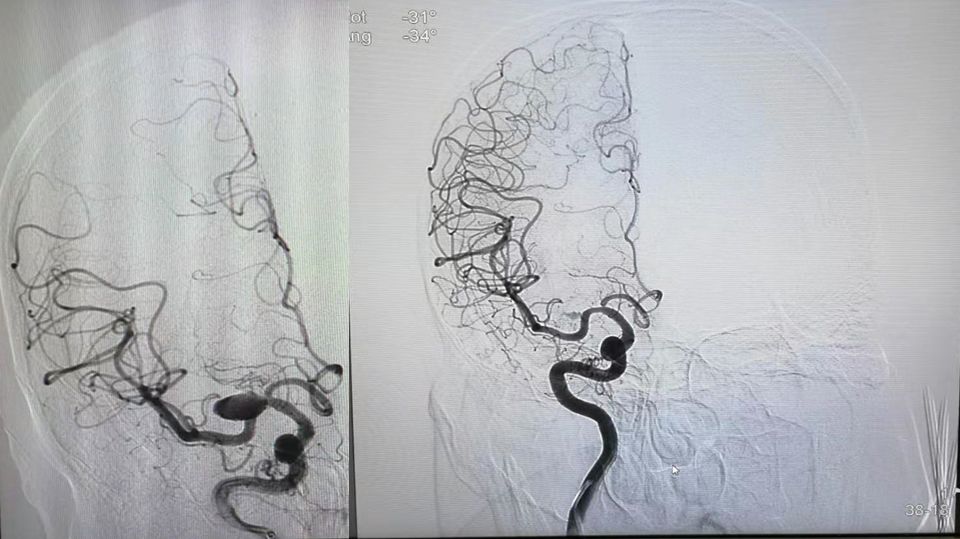 治疗颅内动脉瘤新型密网支架,pipeline治疗椎动脉夹层动脉瘤