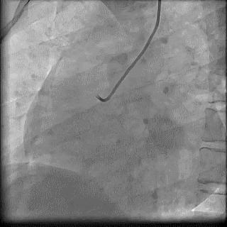 冠脉造影技术成熟不,跟我学技术分析从入门到精通