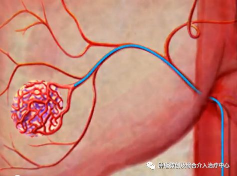 运城市第一医院介入科特色技术——肿瘤的化疗栓塞术