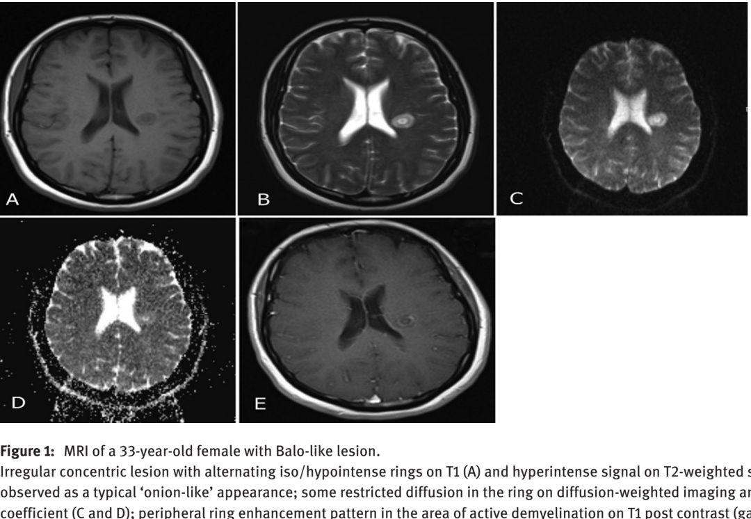 Whipple病、纹状体手、神经结节病、脱髓鞘假瘤丨3分钟读片·第16期