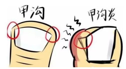 烦人的甲沟炎到底该咋办,特别严重的甲沟炎