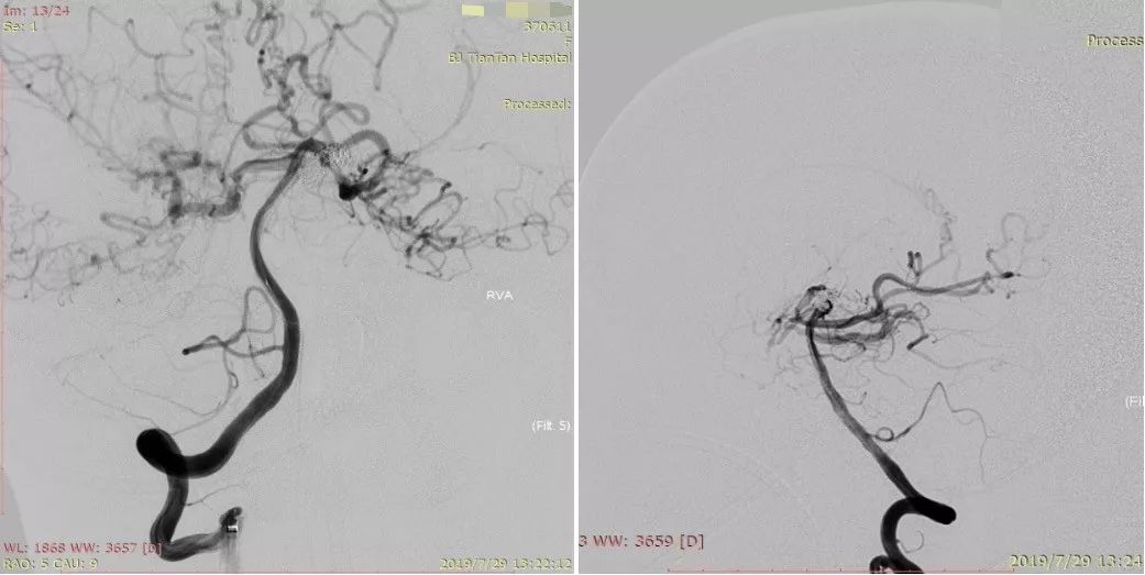 物华天宝·第12期｜复发多发动脉瘤合并烟雾病的支架辅助弹簧圈栓塞治疗