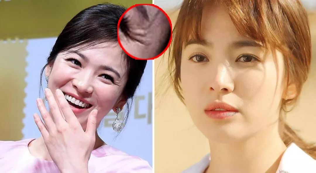 法令纹和眼纹怎么才能有效改善,法令纹贴眼贴有用吗