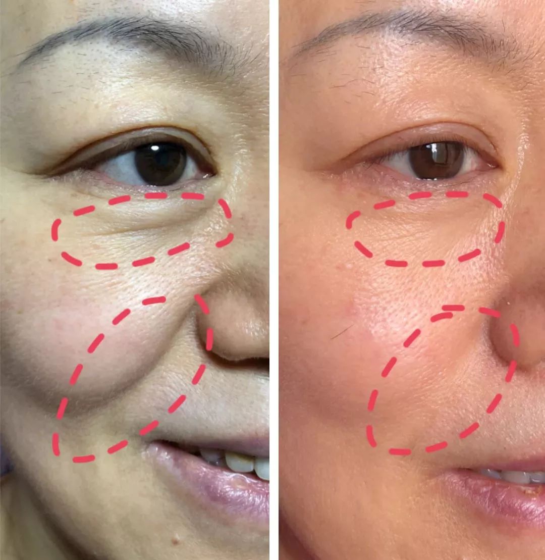 法令纹和眼纹怎么才能有效改善,法令纹贴眼贴有用吗