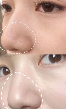 日本草莓鼻去黑头最有效的产品,byebye草莓鼻去黑头神器大揭秘