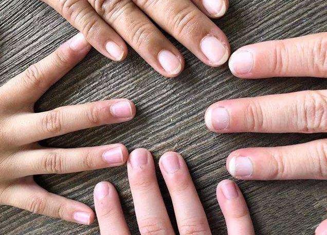 灰指甲与甲癣有什么区别,灰指甲又叫甲癣早期表现为甲沟炎