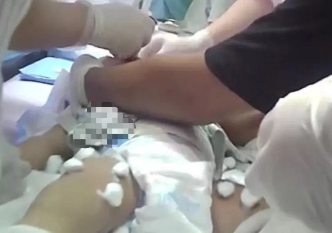 封针治疗脑瘫最新视频,针刀疗法可以治疗脑瘫吗