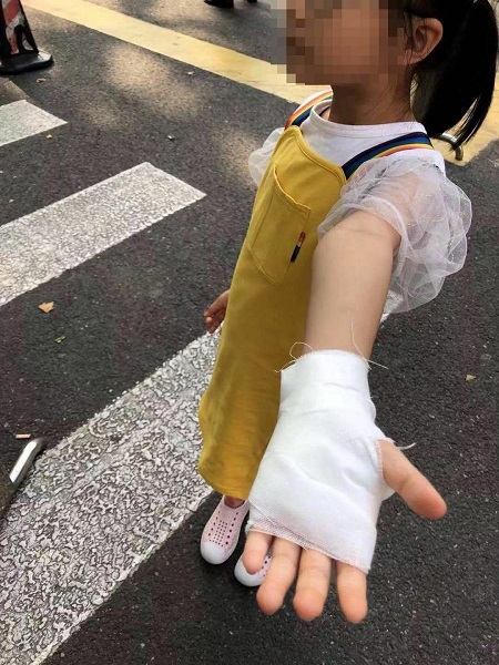 饮水机热水烫伤,饮水机热水烫小孩