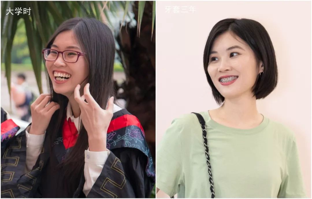 戴牙套改变了脸型可以恢复吗,戴牙套改变颜值