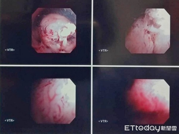 她健检发现尿带血　医一探惊见子宫像钟乳石洞：确诊罹癌了