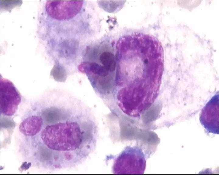 全血细胞减少疾病，你还傻傻分不清？