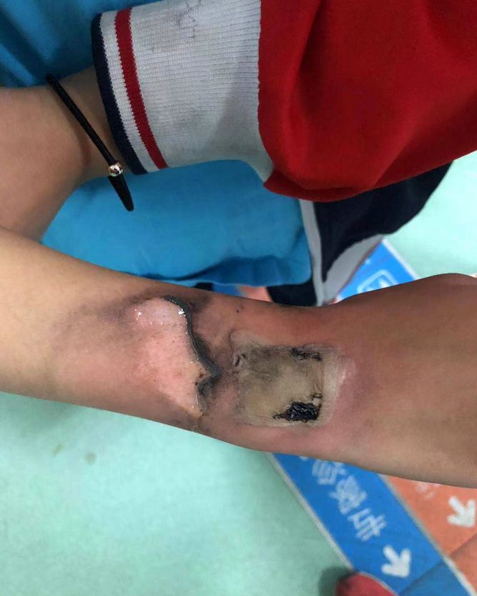 @荆门家长!你家孩子经常戴的这东西出事了!